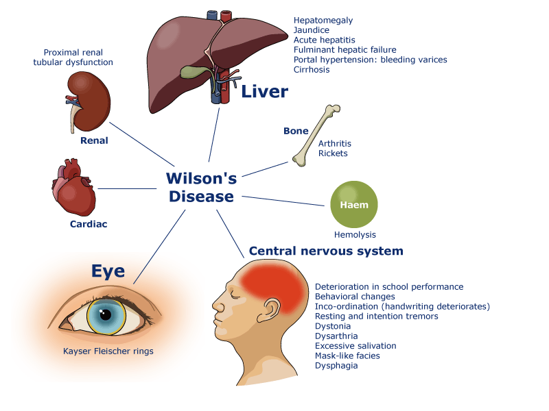 Image result for Wilson's disease