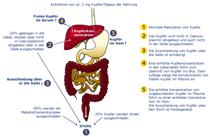 Diagram II: Wilson's disease patients before treatment: reduced excretion and retention of copper